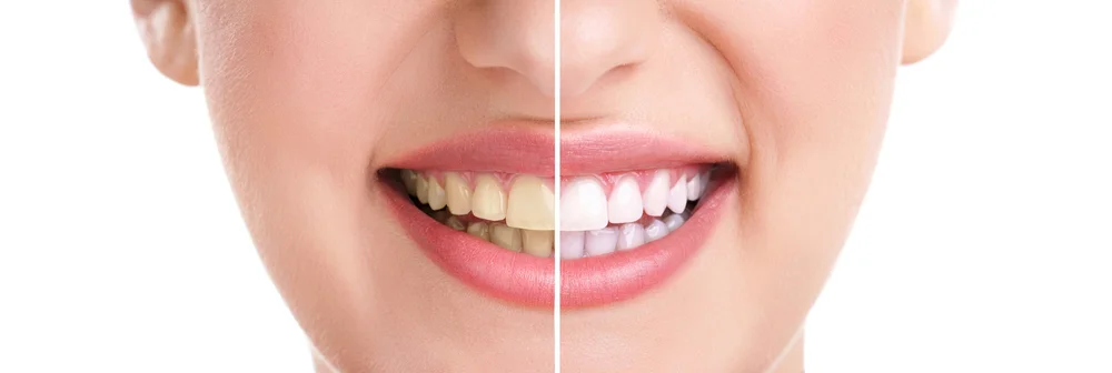 Podzielone na pół zdjęcie uśmiechu kobiety przed i po zabiegach w Dental-Wit. Po lewej zęby z przebarwieniami, po prawej jasny, harmonijny uśmiech po wybielaniu gabinetowym i odbudowie krawędzi.