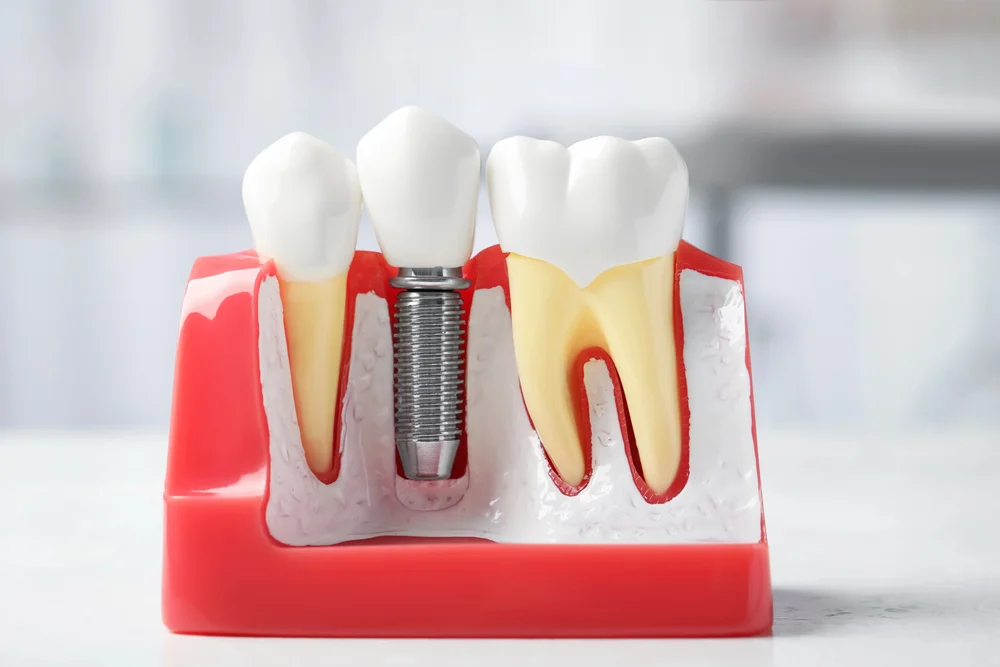 Model anatomiczny przedstawiający tytanowy implant zębowy wszczepiony w kość w miejscu brakującego zęba naturalnego.