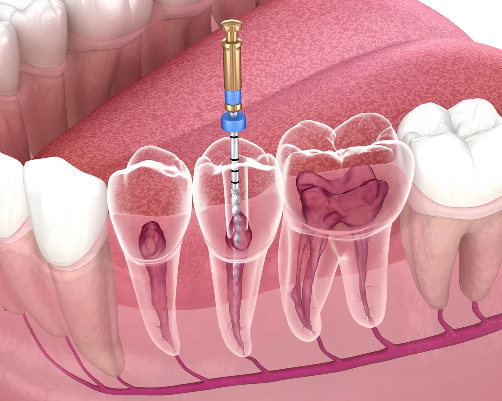 Ilustracja medyczna przedstawiająca precyzyjne czyszczenie i leczenie kanałowe zęba przy użyciu specjalistycznych narzędzi endodontycznych.