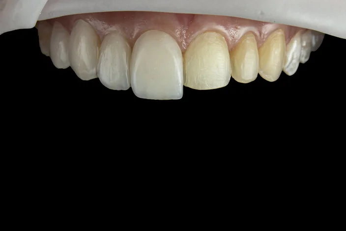 Metamorfoza uśmiechu z wykorzystaniem licówek porcelanowych na górnych zębach w gabinecie Dental-Wit. Efekt to symetryczny uśmiech o naturalnych proporcjach.