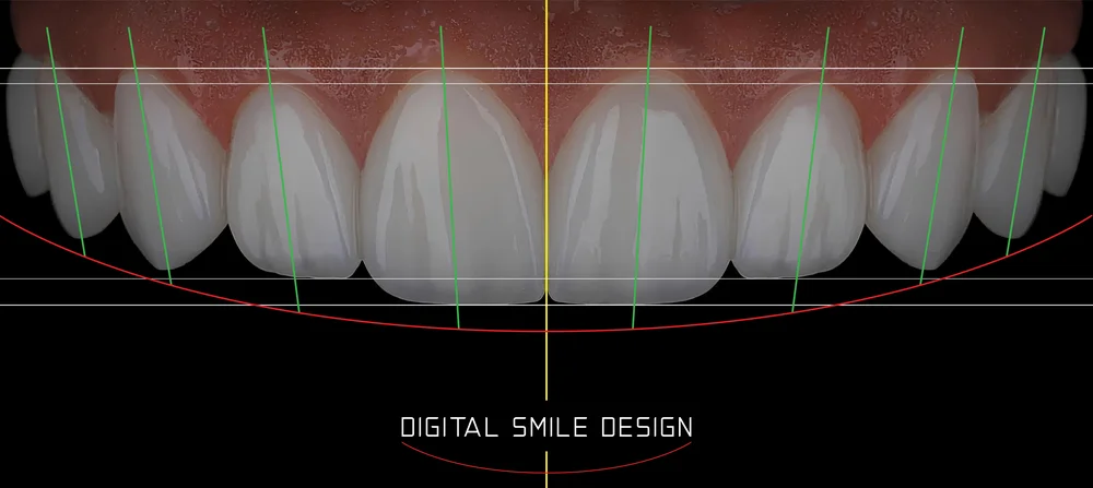 Cyfrowa analiza i projektowanie estetyki uśmiechu na modelu uzębienia w ramach stomatologii estetycznej Dental-Wit.