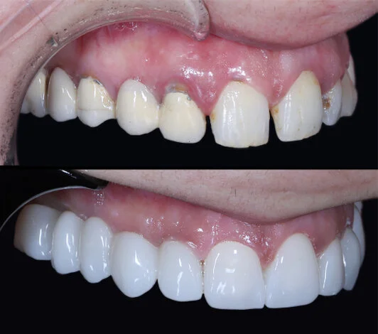 Zestawienie uśmiechu przed i po kompleksowej odbudowie w Dental-Wit. Na górze widoczne rozległe ubytki, na dole stabilny, pełny uśmiech dzięki implantom i protetyce.