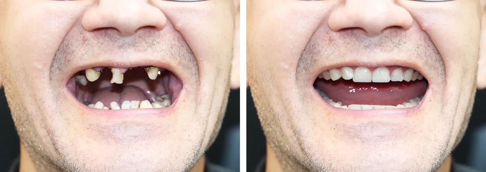 Całkowita odbudowa uzębienia przed i po – Dental-Wit Będzin Zestawienie uśmiechu pacjenta przed i po metamorfozie. Po lewej stronie widoczne znaczne braki zębowe, po prawej pełna, estetyczna odbudowa protetyczna wykonana w Dental-Wit.
