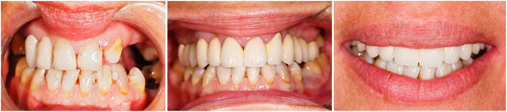 Kompleksowe leczenie protetyczne krok po kroku – dentysta Będzin Proces kompleksowej metamorfozy uśmiechu. Trzy kadry pokazują stan początkowy z widocznymi starciami, środkowy etap leczenia protetycznego oraz finałowy efekt z równymi i jasnymi zębami.