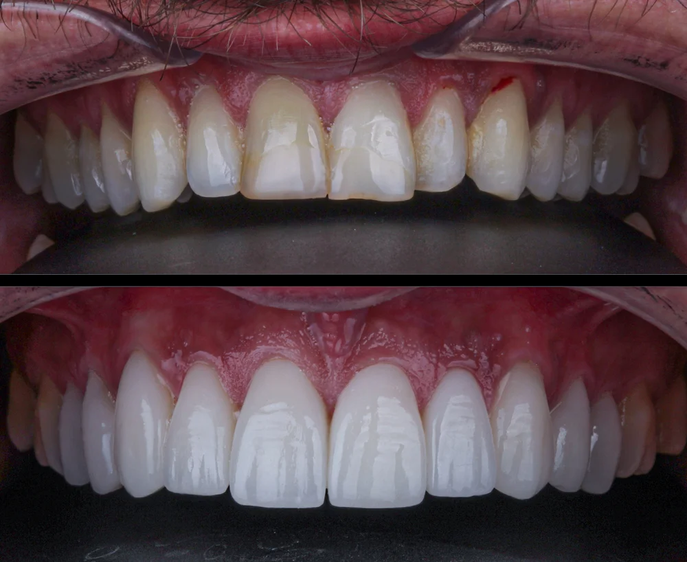 Metamorfoza uśmiechu przed i po – stomatolog Dental-Wit Będzin Zestawienie dwóch zdjęć uzębienia pacjenta przed i po leczeniu stomatologicznym, ukazujące spektakularną metamorfozę uśmiechu w klinice Dental-Wit.